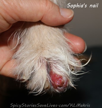 Leishmaniasis attacked some of Sophia's nails, turning them brittle and crooked, and making the nail beds raw and bloody.